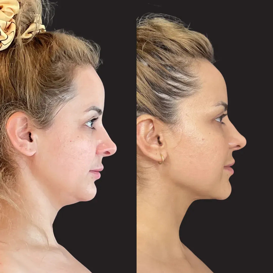 Neck and jawline treatment at the L'amour De Soi clinic